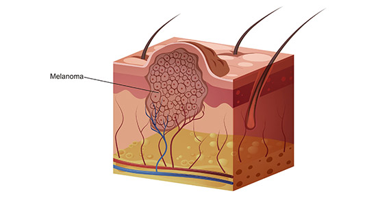 skin cancer